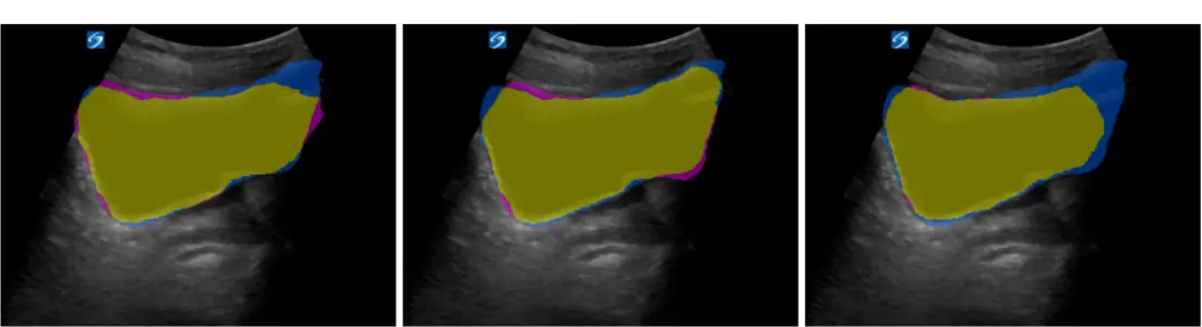 ThorMed Bladder Segmentation Project by Henry Vu: Medical ultrasound image segmentation for edge deployment